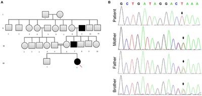 A SLC16A1 Mutation in an Infant With Ketoacidosis and Neuroimaging Assessment: Expanding the Clinical Spectrum of MCT1 Deficiency